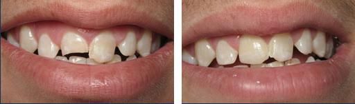 A recent cosmetic dentistry job in the Huron, SD area