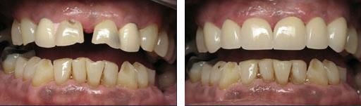 A recent dental crowns job in the Huron, SD area