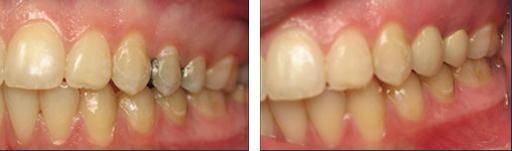 A recent dental crowns job in the  area