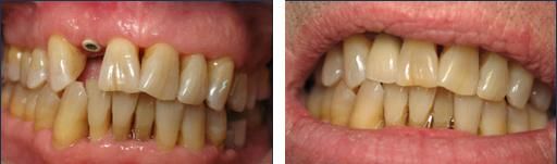 A recent implant dentists job in the Huron, SD area