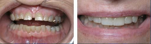A recent tooth crowns job in the Huron, SD area